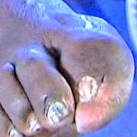 shaqstoe